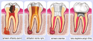 איור של שלבי הטיפול בשורש השיניים